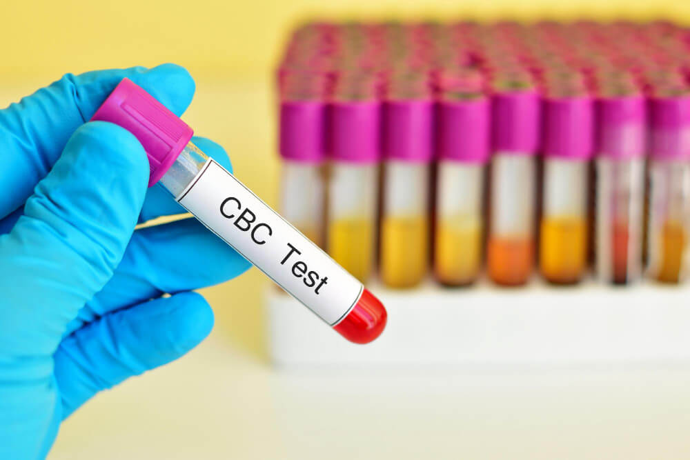 Understanding Complete Blood Count (CBC) Tests: What Do Your Results Mean?